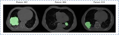 A dual-radiomics model for overall survival prediction in early-stage NSCLC patient using pre-treatment CT images